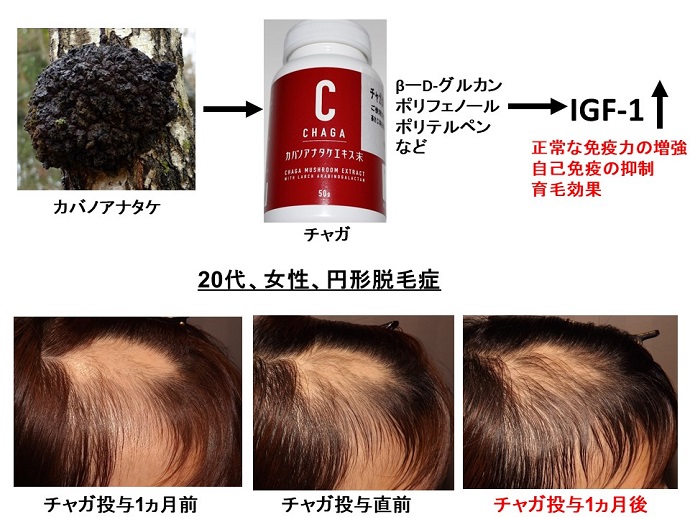 円形脱毛症　病院